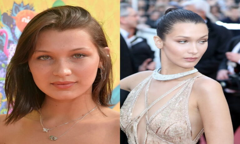 Bella Hadid avant après sa chirurgie esthétique