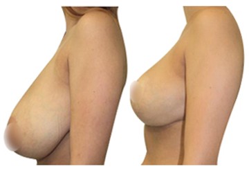 breast lift in unisia before and after
