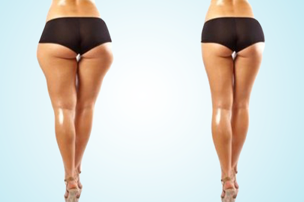 buttock augmentation before and after