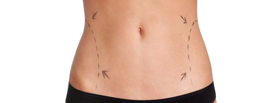 ABDOMINOPLASTIE Archives - Blog Univers-med