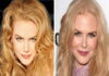 Nicole Kidman chirurgie esthetique