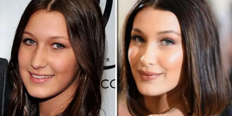 Bella Hadid Avant Après Sa Chirurgie Esthétique